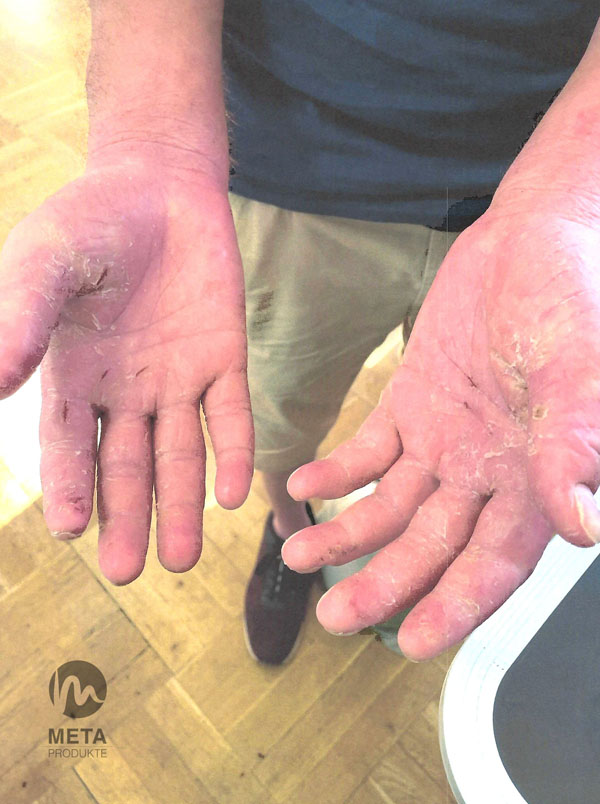 Hände vor der Behandlung CBD Balsam