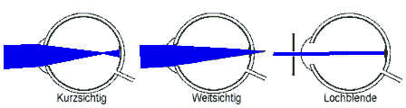 Prinzip der Rasterbrille Grafik vom Auge bei Kurz- und Weitsichtigkeit und beim Tragen der Lochbrille